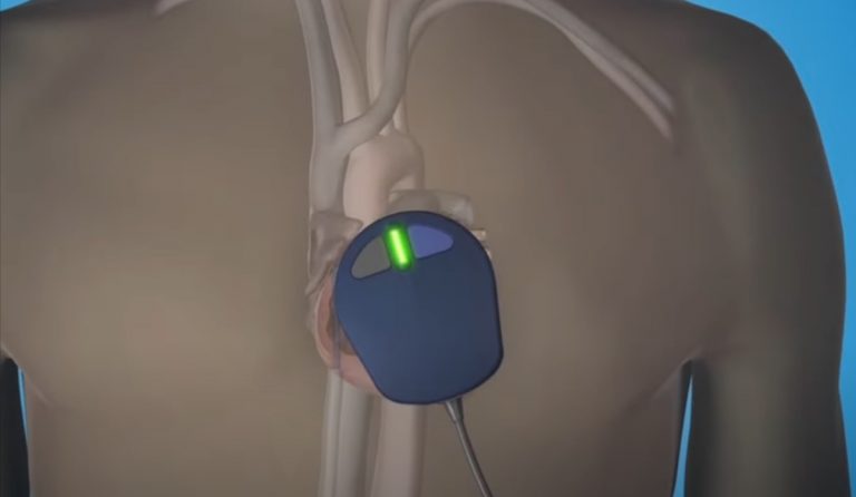 Ricovero Mattarella per impianto pacemaker, a cosa serve l’intervento e come funziona il dispositivo Ricovero Mattarella per impianto pacemaker, a cosa serve l’intervento e come funziona il dispositivo