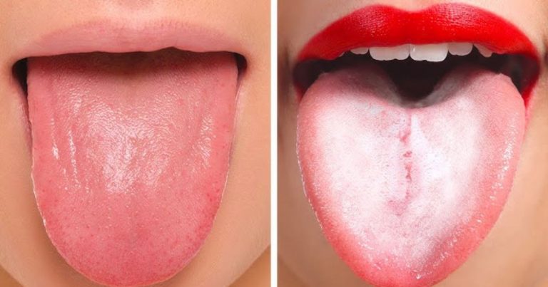 La lingua ci avvisa se nel nostro corpo c’è qualcosa che non va, il Dottor Cugini svela i segnali cui prestare attenzione La lingua ci avvisa se nel nostro corpo c’è qualcosa che non va, il Dottor Cugini svela i segnali cui prestare attenzione