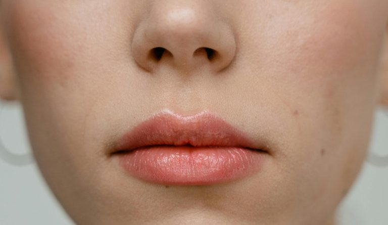 Labbra secche e screpolate, segnali da non sottovalutare: ecco quando rivolgersi al medico Labbra secche e screpolate, segnali da non sottovalutare: ecco quando rivolgersi al medico
