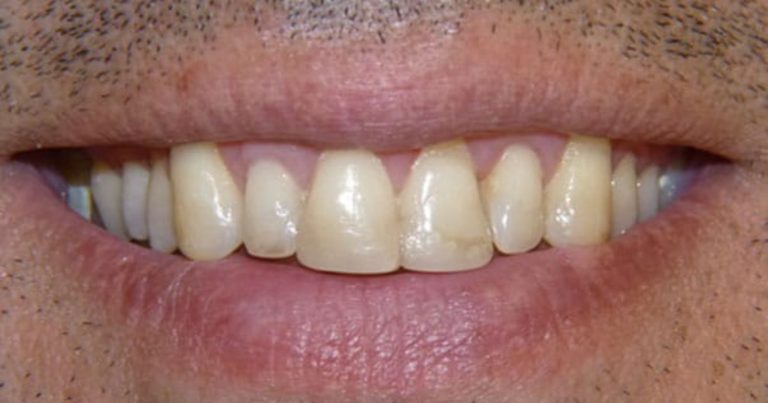 Va dal dentista perché le gengive continuavano a sanguinare: era il sintomo di una grave malattia Va dal dentista perché le gengive continuavano a sanguinare: era il sintomo di una grave malattia