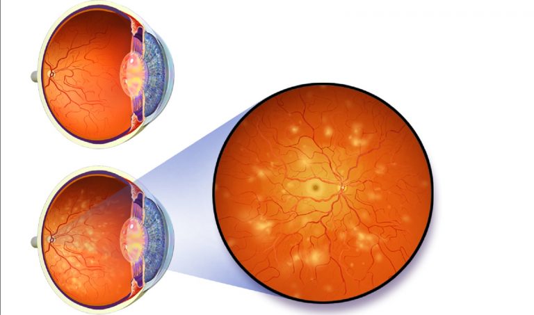 Retinopatia, tipologie, cause e segnali che ne preannunciano l’arrivo Retinopatia, tipologie, cause e segnali che ne preannunciano l’arrivo