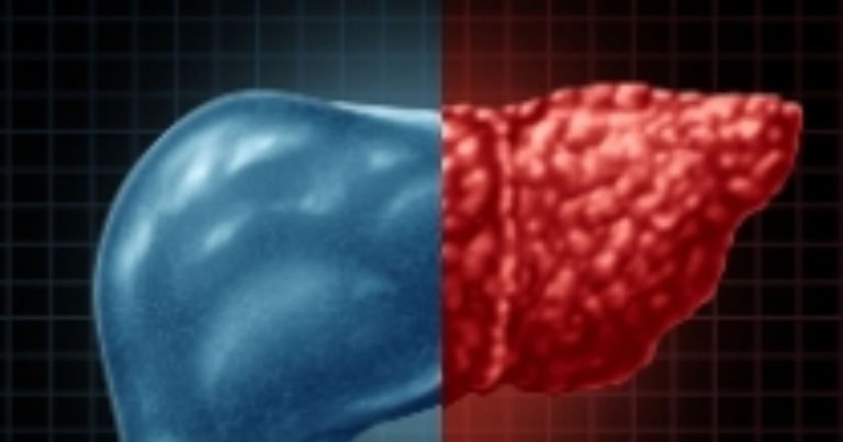 Cirrosi, come prevenirla e quali sono i sintomi cui prestare attenzione Cirrosi, come prevenirla e quali sono i sintomi cui prestare attenzione
