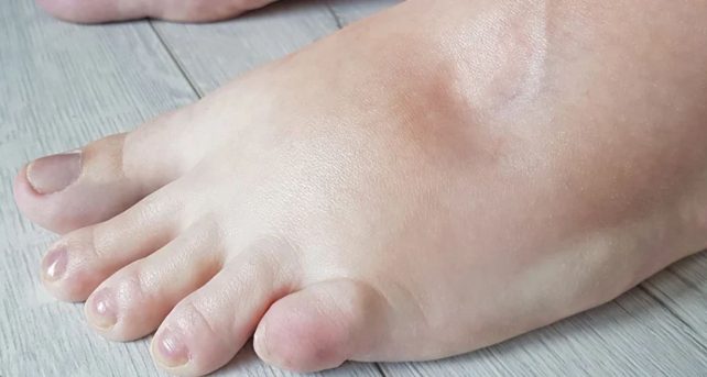 piedi gonfi