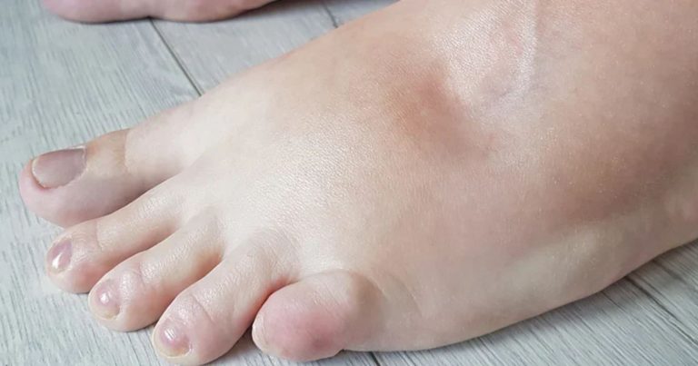 Piedi gonfi: i sintomi che devono mettere in guardia spiegati dal dottor Pierluigi Vandone