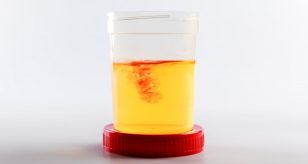 sangue nelle urine