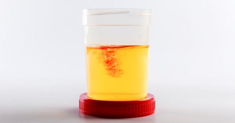 Sangue nelle urine, il Dottor Lovisolo svela le cause e i fattori di rischio: ecco quando rivolgersi al medico Sangue nelle urine, il Dottor Lovisolo svela le cause e i fattori di rischio: ecco quando rivolgersi al medico