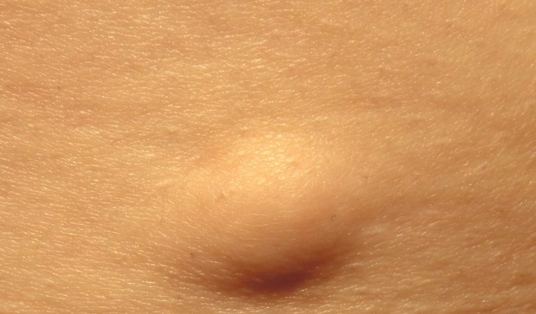 Lipomi, la dottoressa Laura Colombo spiega cosa sono e come riconoscerli