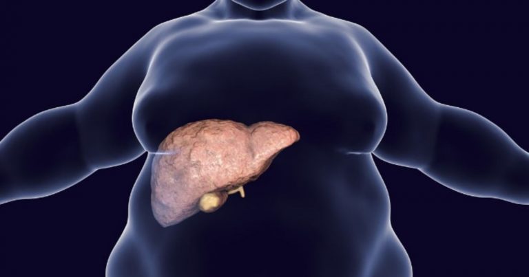 Steatosi, è una patologia che può colpire persone di qualsiasi età: ecco qual è il sintomo più comune