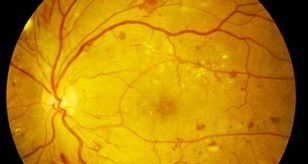 retinopatia