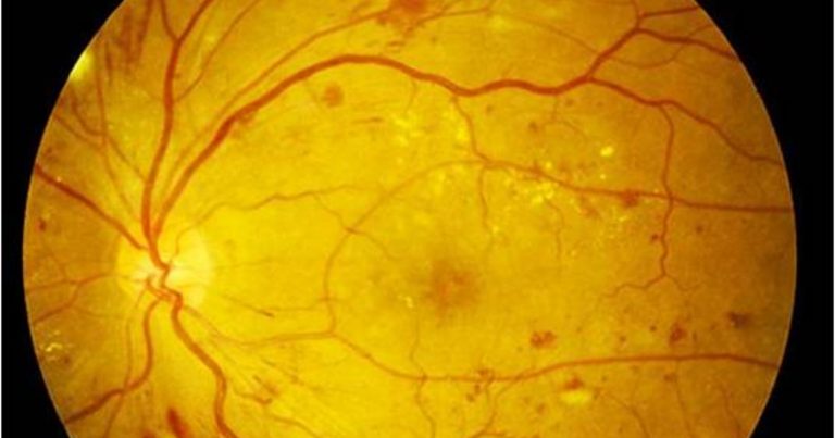 Retinopatia, ogni anno può colpire 20.000 italiani, ecco quali sono i sintomi che devono mettere in guardia Retinopatia, ogni anno può colpire 20.000 italiani, ecco quali sono i sintomi che devono mettere in guardia