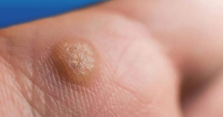 Condilomi, il Dottor Boccasanta spiega quali sono i sintomi più comuni per riconoscerli Condilomi, il Dottor Boccasanta spiega quali sono i sintomi più comuni per riconoscerli