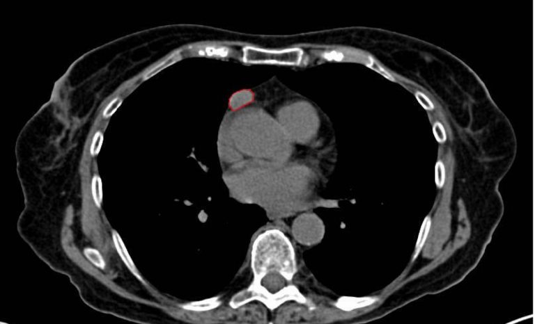 Timoma, la Prof. Giulia Veronesi spiega di cosa si tratta e quali sono i sintomi