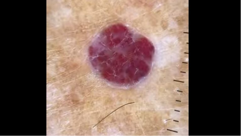 Angioma cutaneo, di cosa si tratta e quali sono i sintomi
