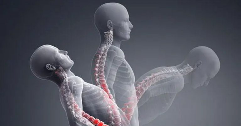 Spondilite anchilosante, di cosa si tratta e qual è il sintomo precoce (e più tipico)