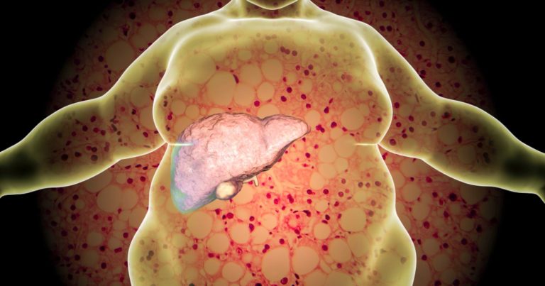 Steatosi epatica, il professor Alessio Aghemo spiega quali sono i sintomi e come si diagnostica il fegato grasso