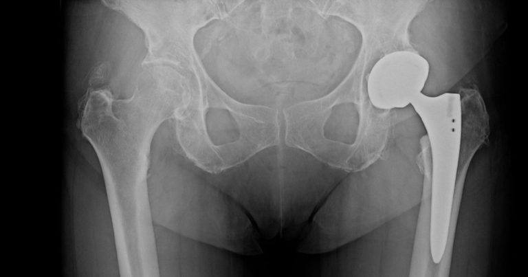 Coxartrosi (artrosi dell’anca), il dottor Pierantonio Gardelin spiega qual è il sintomo spesso sottovalutato