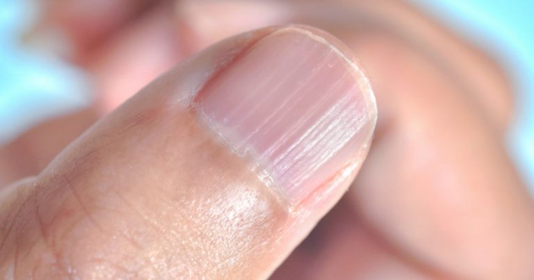 Unghie con righe verticali: ecco quali sono le possibili cause e i rimedi