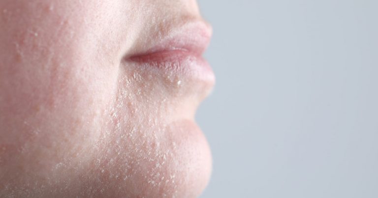 Pelle secca, un sintomo che può indicare queste malattie: quando è necessario consultare il medico