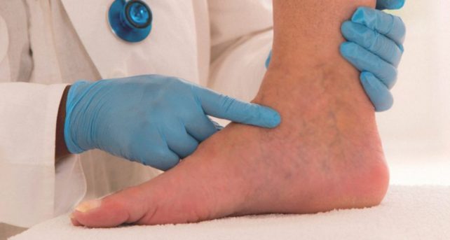 edema