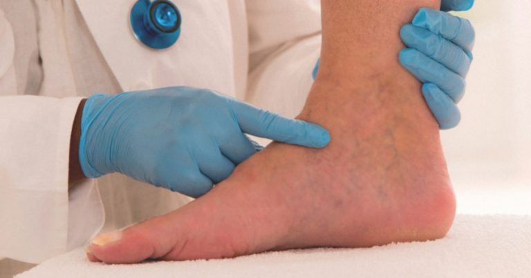 Edema, ecco come riconoscerlo, le possibili cause del gonfiore, come prevenirlo e trattarlo