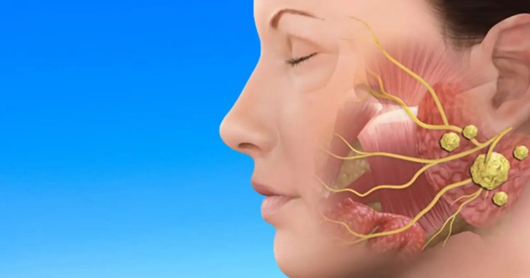 Ghiandole salivari gonfie, il Prof. Giordano spiega quali sono i sintomi associati e quali patologie possono nascondere