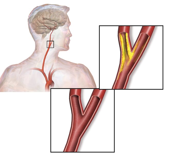 Stenosi carotidea, di cosa si tratta, perché è pericolosa e quali sono i sintomi