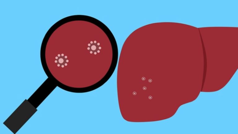 Epatite A, boom di casi in Campania: ecco quali sono i sintomi, come avviene il contagio e cosa fare per prevenirla