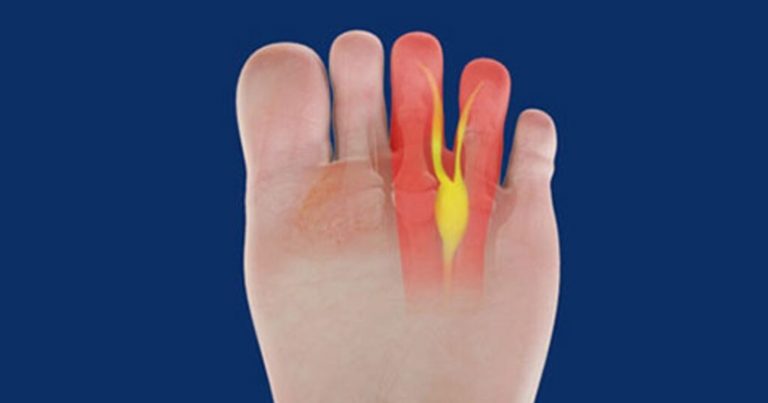 Neuroma di Morton, il dottor Federico Usuelli spiega quali sono i sintomi e come si diagnostica
